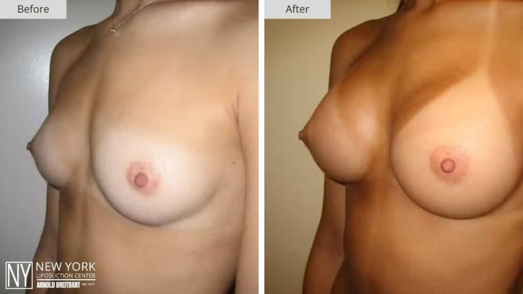 Breast Augmentation Before and After Patient 5