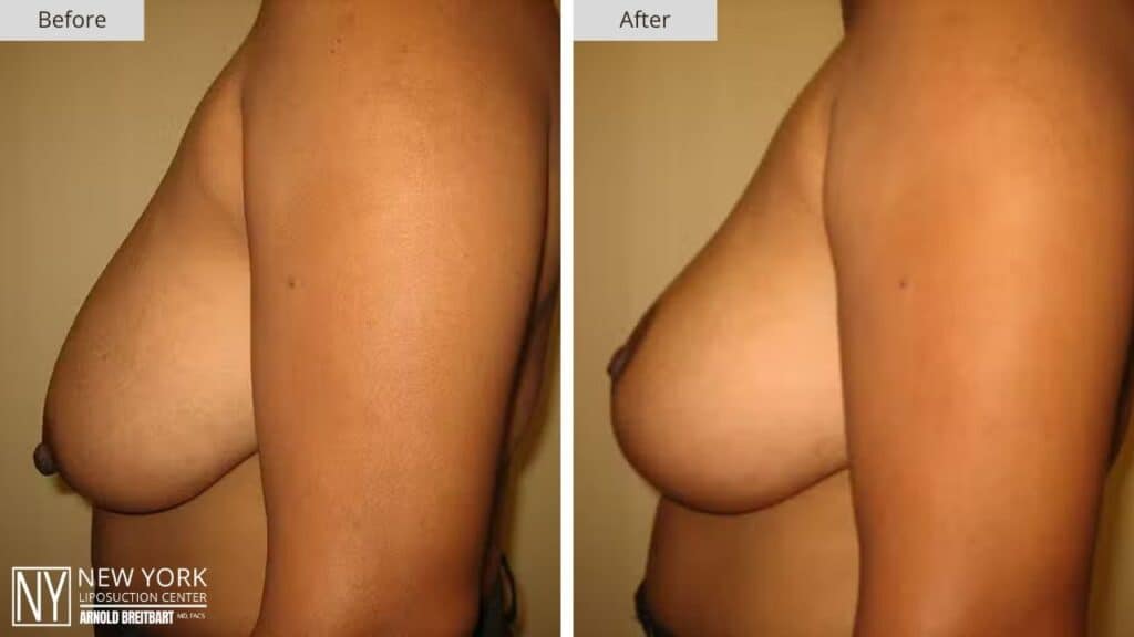 Breast Lift Before and After Patient 1