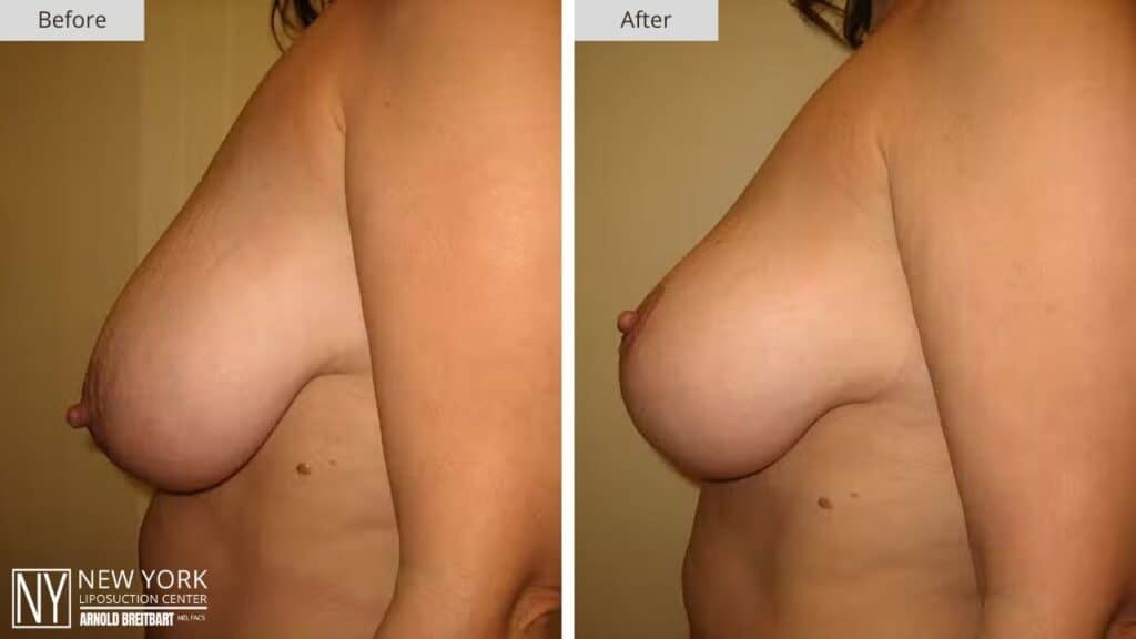 Breast Lift Before and After Patient 2