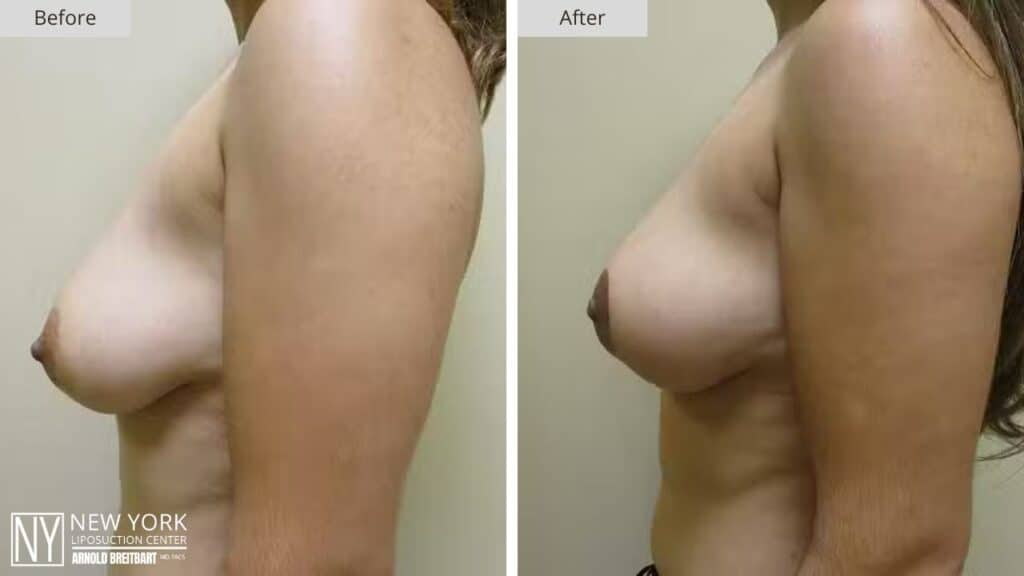 Breast Lift Before and After Patient 3