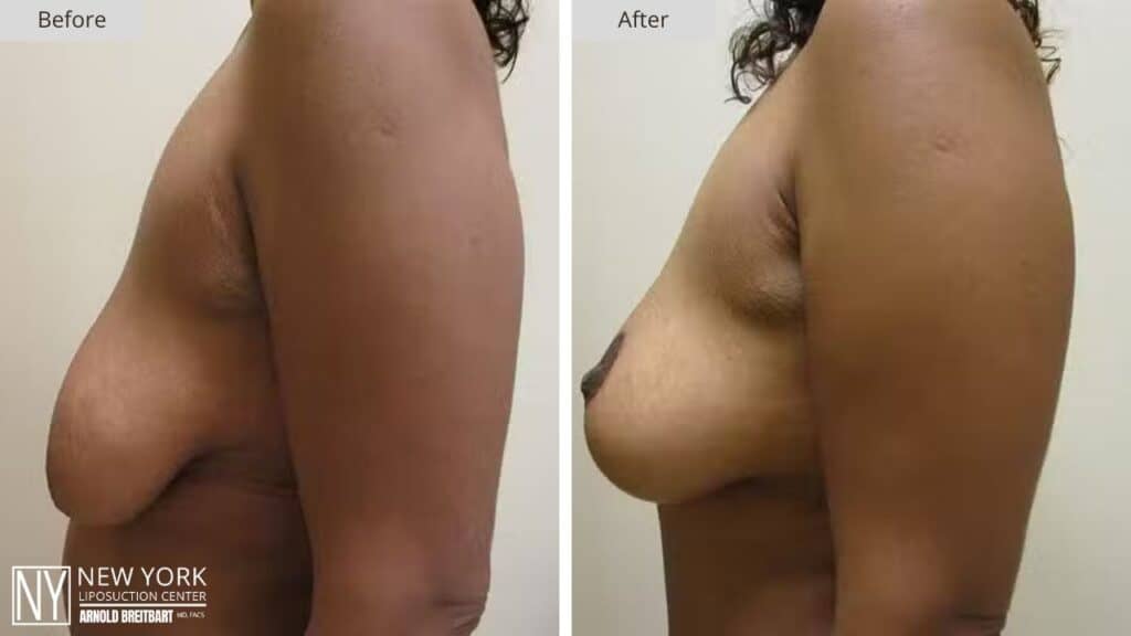 Breast Lift Before and After Patient 4