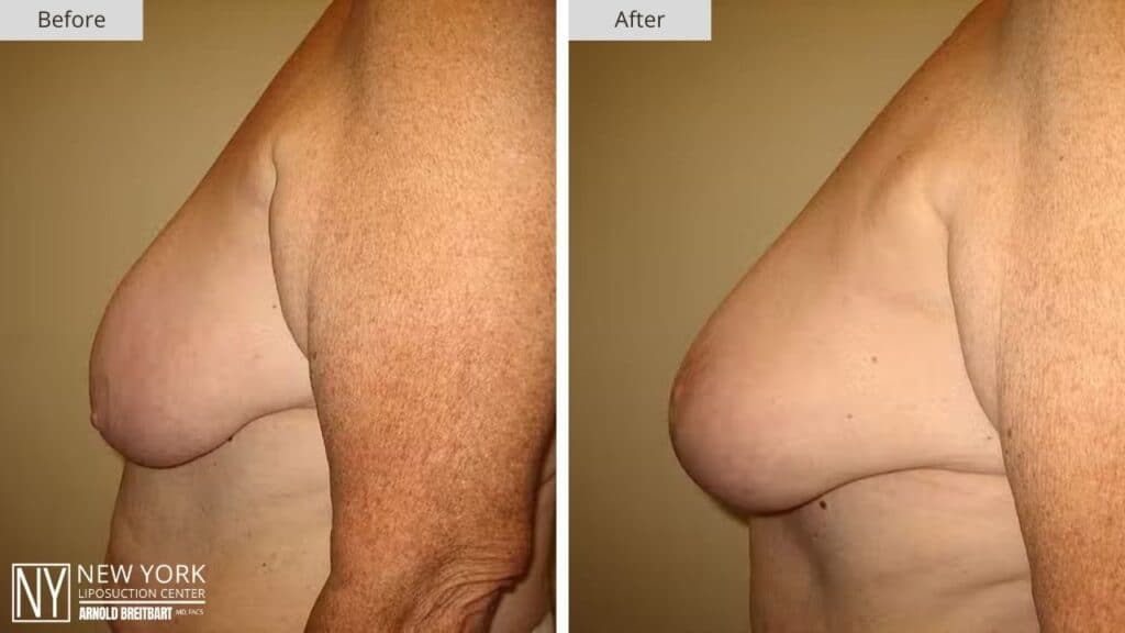 Breast Lift Before and After Patient 5