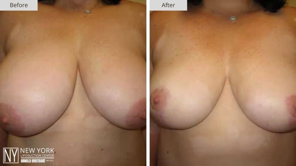 Breast Reduction Before and After Patient 1