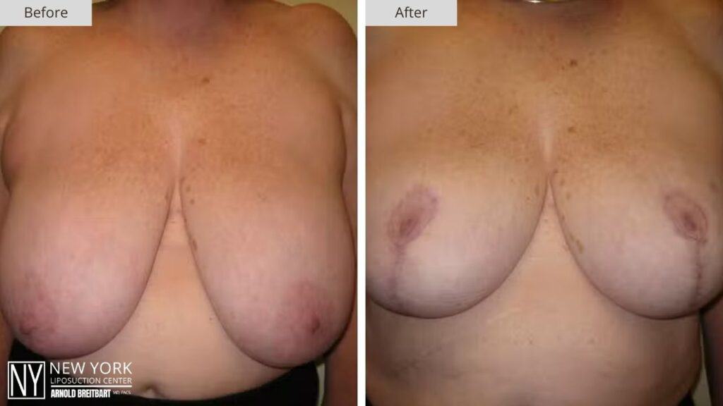 Breast Reduction Before and After Patient 2