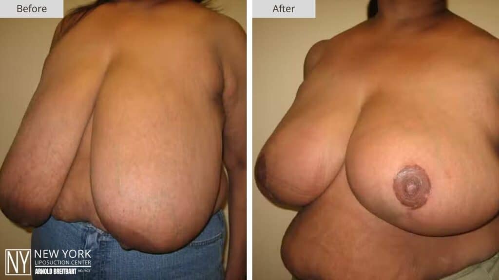 Breast Reduction Before and After Patient 3