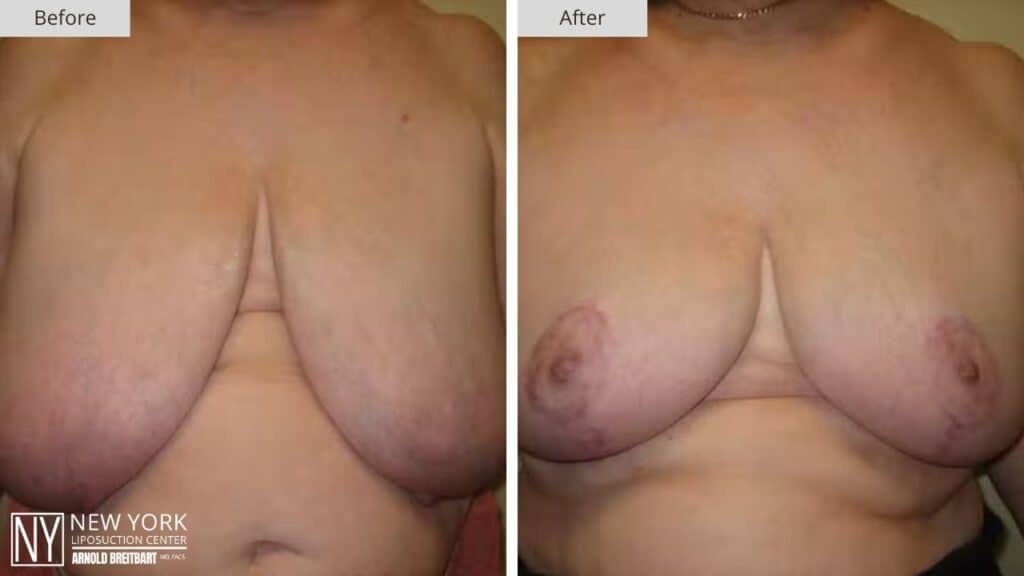 Breast Reduction Before and After Patient 4