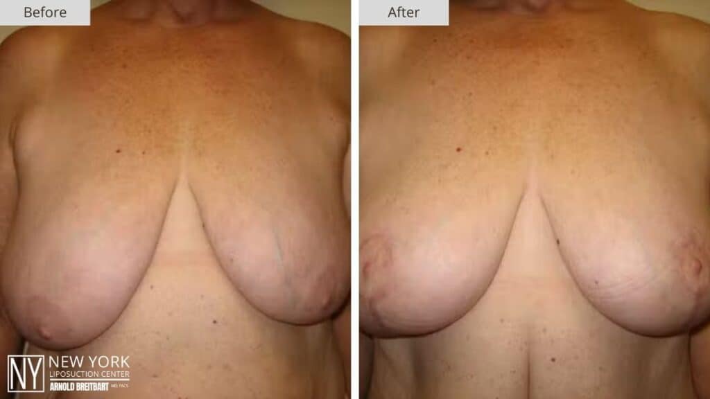 Breast Reduction Before and After Patient 5