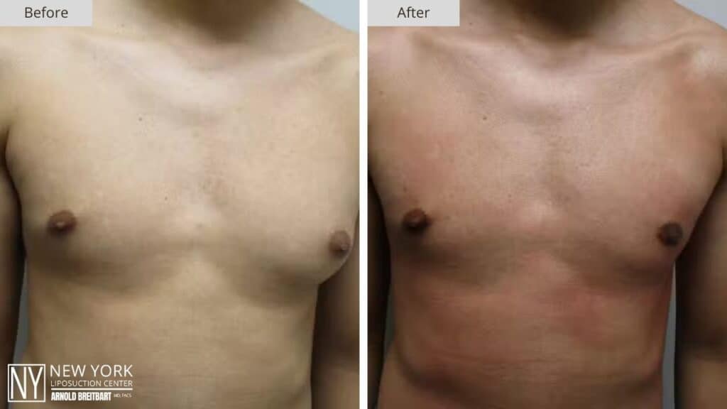 Gynecomastia Before and After Patient 1