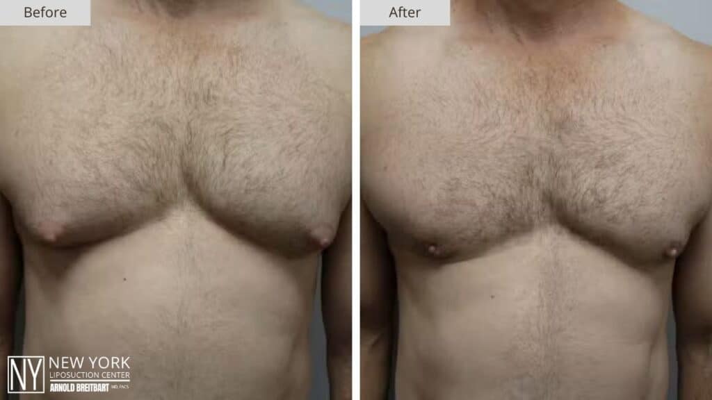 Gynecomastia Before and After Patient 2