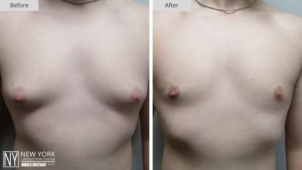 Gynecomastia Before and After Patient 3