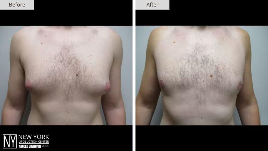 Gynecomastia Before and After Patient 4