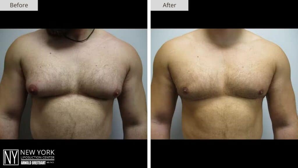 Gynecomastia Before and After Patient 5