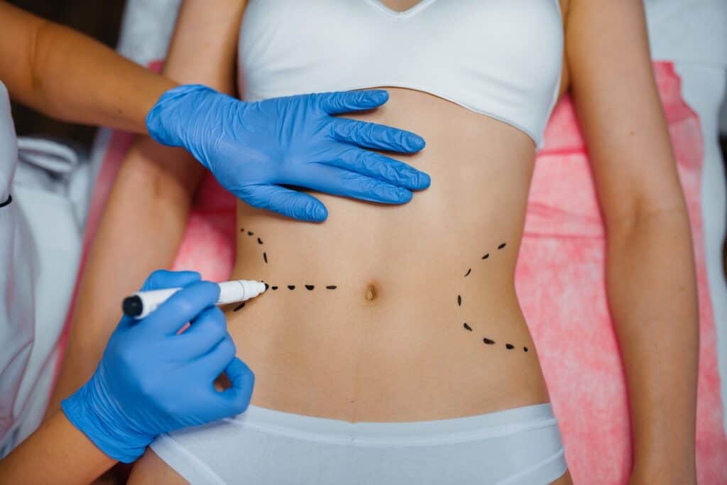 Liposuction