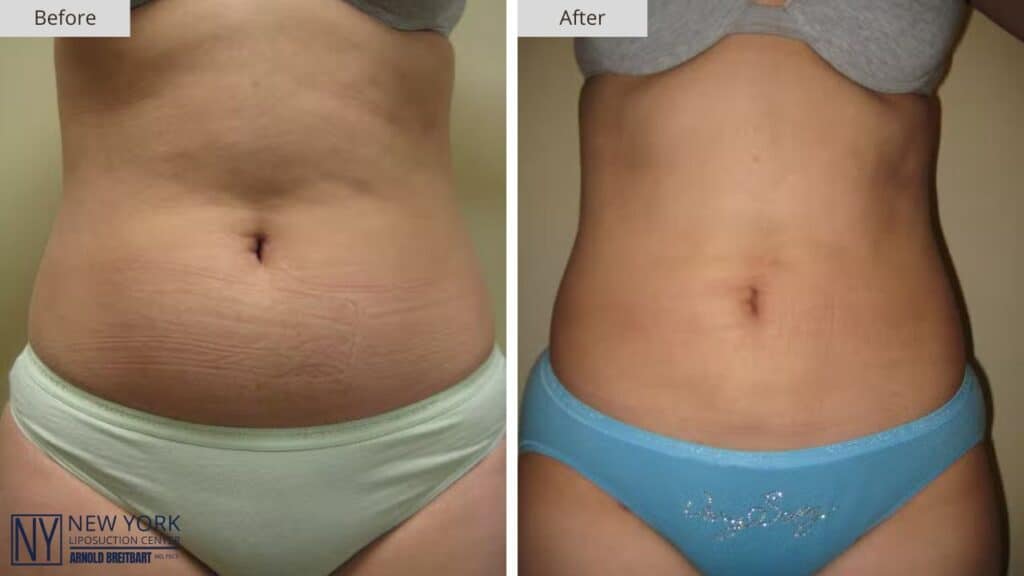 NY Liposuction Before and After Patient #1