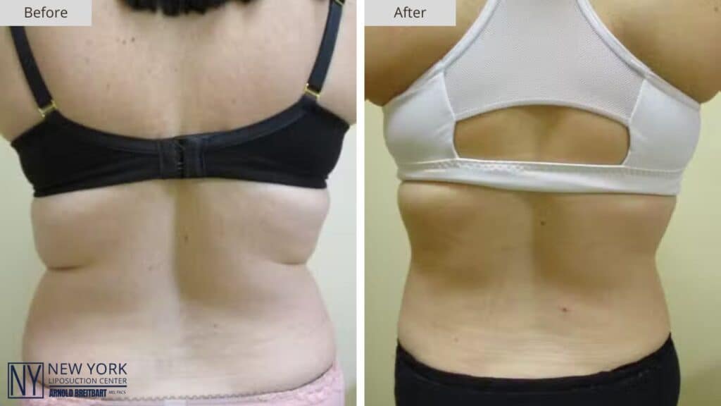 NY Liposuction Before and After Patient #2