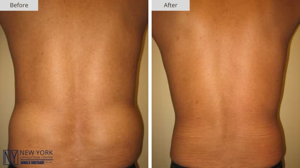 NY Liposuction Before and After Patient #3