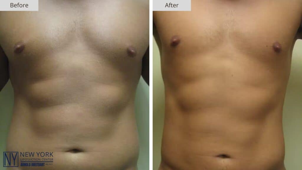 NY Liposuction Before and After Patient #4