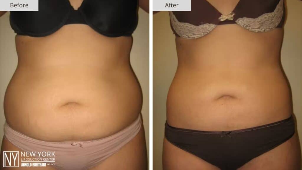 New York Abdomen Liposuction Before and After Front Patient 5