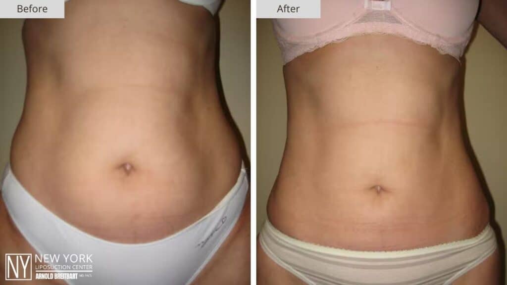 New York Abdomen Liposuction Before and After Front Patient 6