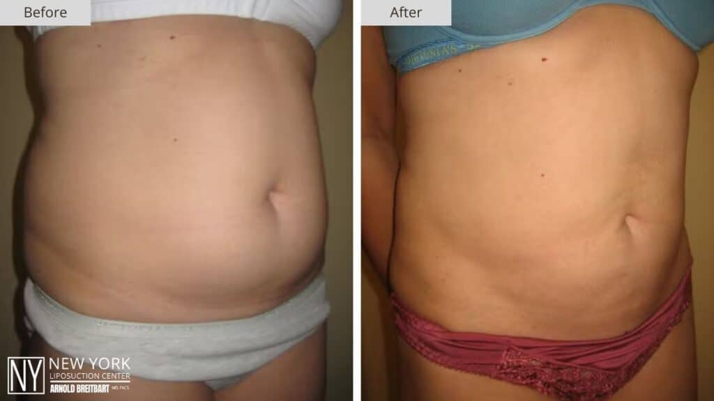 New York Abdomen Liposuction Before and After Front Patient 7