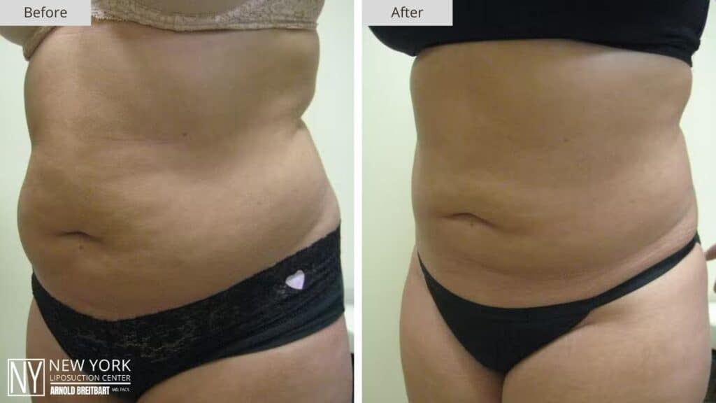 New York Abdomen Liposuction Before and After Front Patient 8