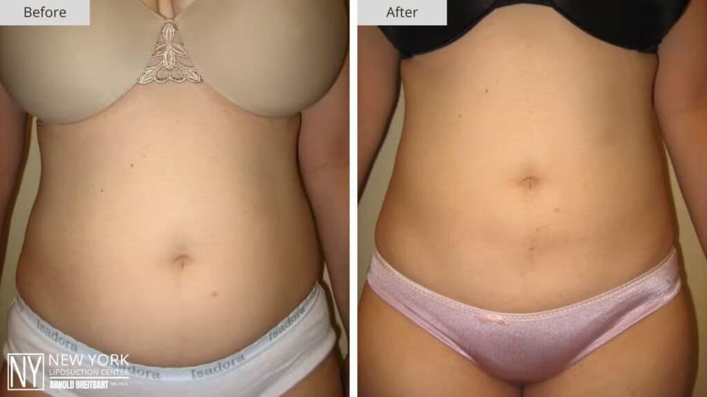 New York Abdomen Liposuction Before and After Front Patient 9