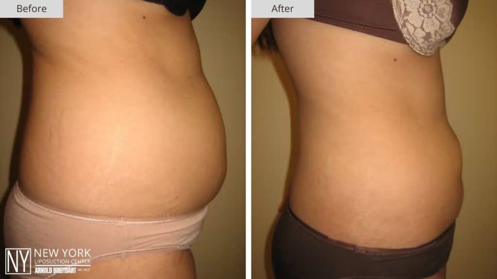 New York Abdomen Liposuction Before and After Side Patient 5