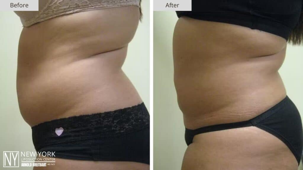 New York Abdomen Liposuction Before and After Side Patient 8