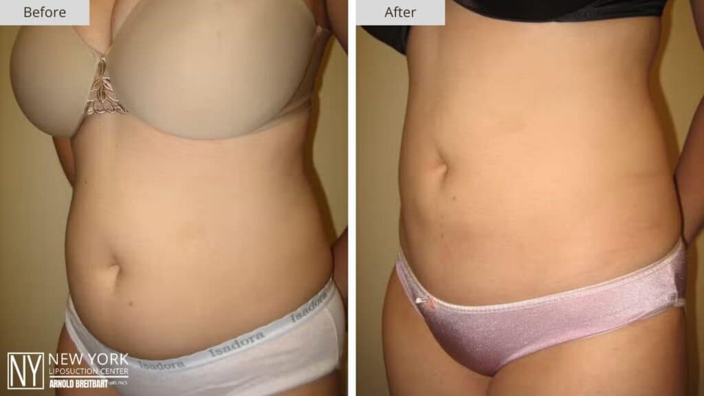 New York Abdomen Liposuction Before and After Side Patient 9