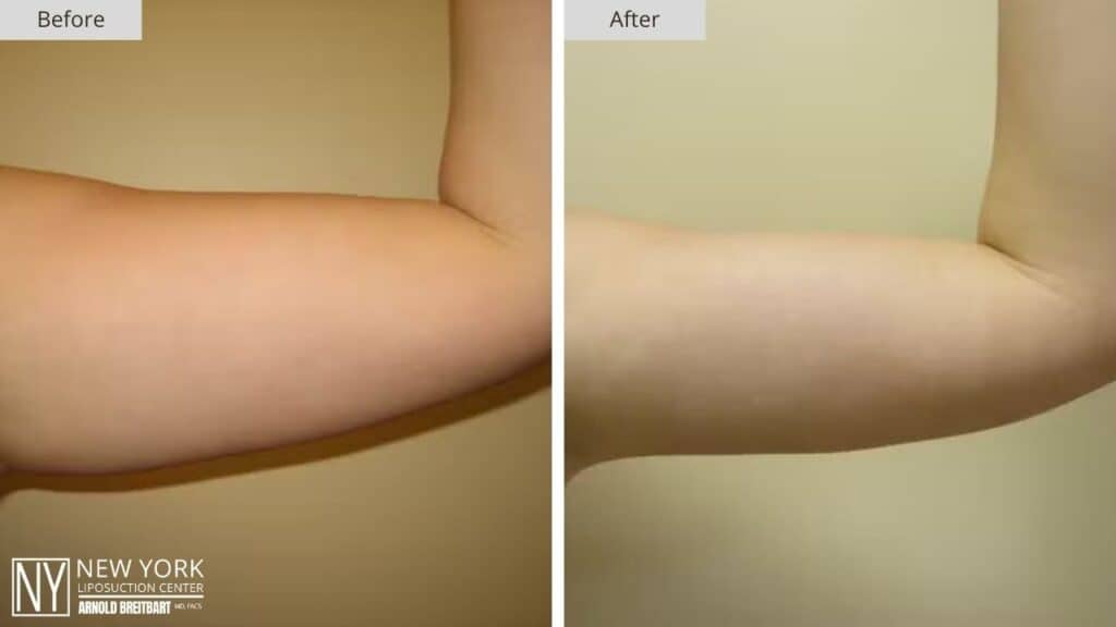 New York Arm Liposuction Before and After Front Patient 1 Left