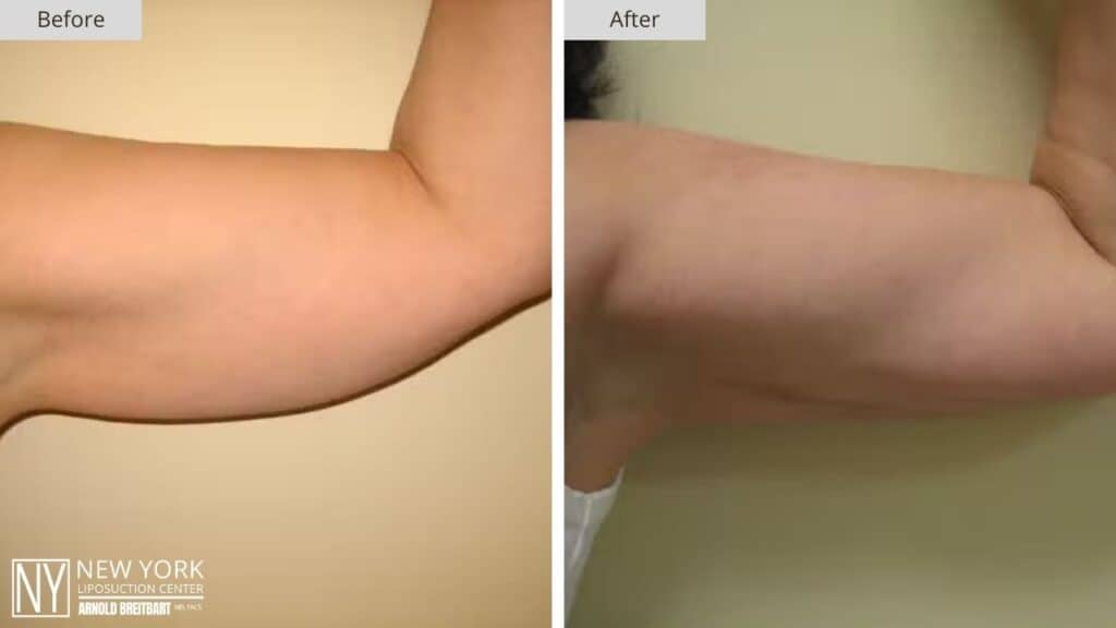 New York Arm Liposuction Before and After Front Patient 1 Left (2)