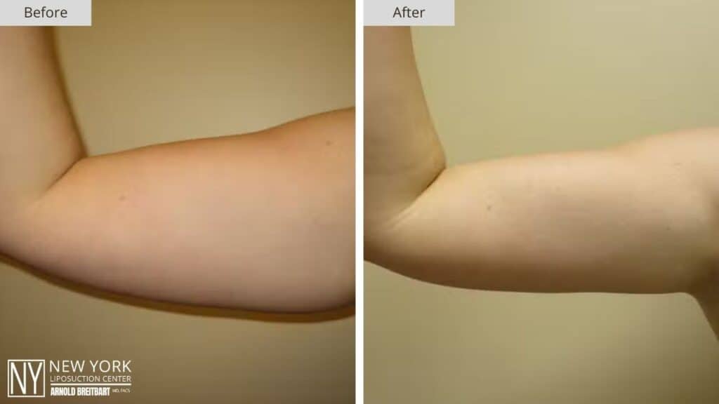 New York Arm Liposuction Before and After Front Patient 1 Right