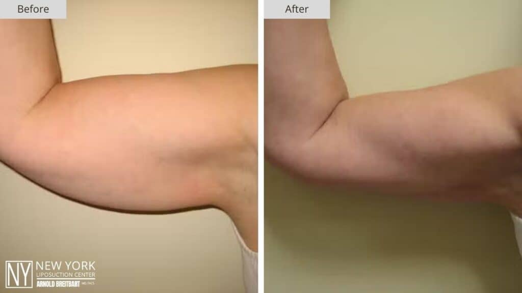 New York Arm Liposuction Before and After Front Patient 1 Right (2)