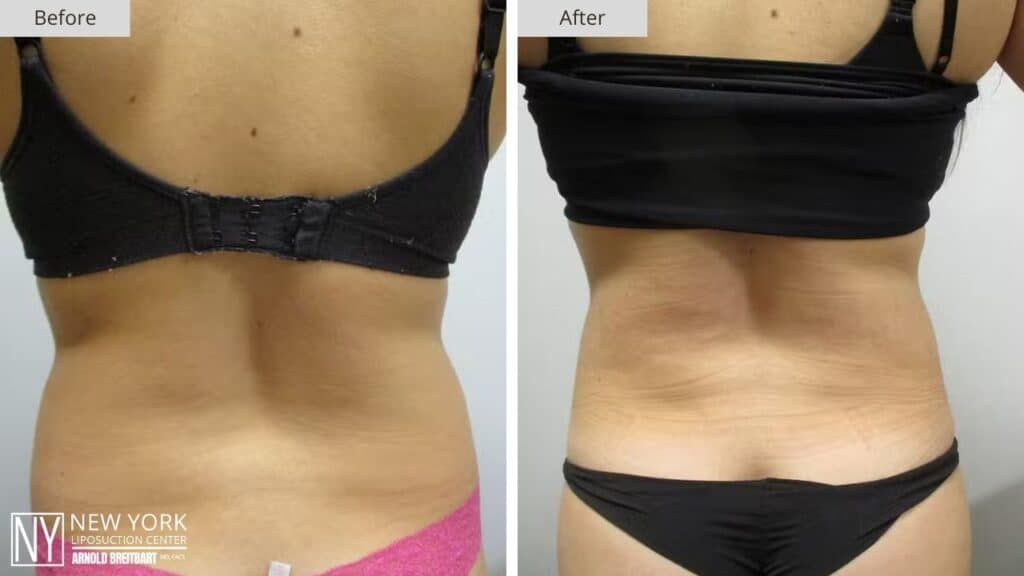 New York Back Liposuction Before and After Patient 1