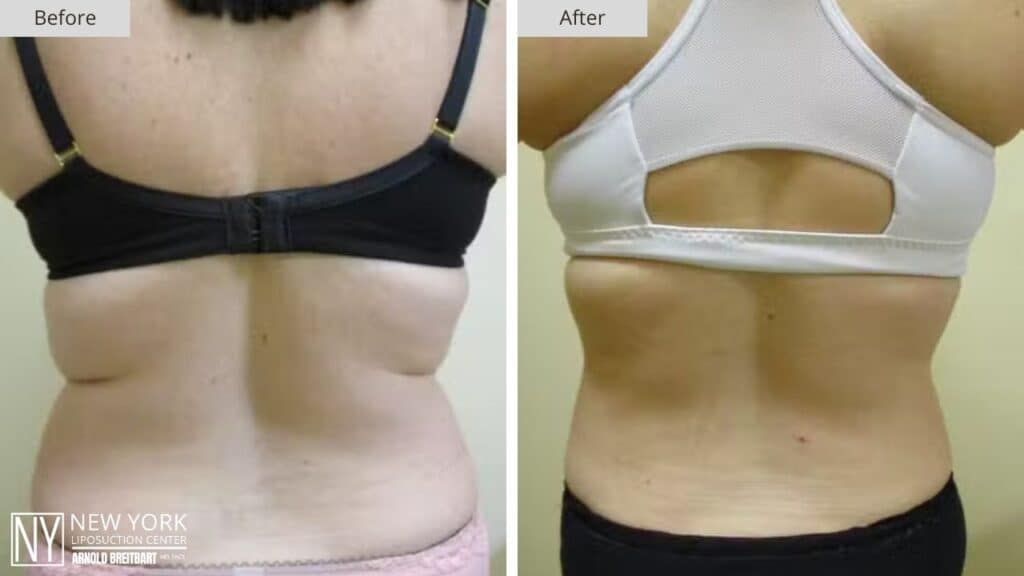 New York Back Liposuction Before and After Patient 2