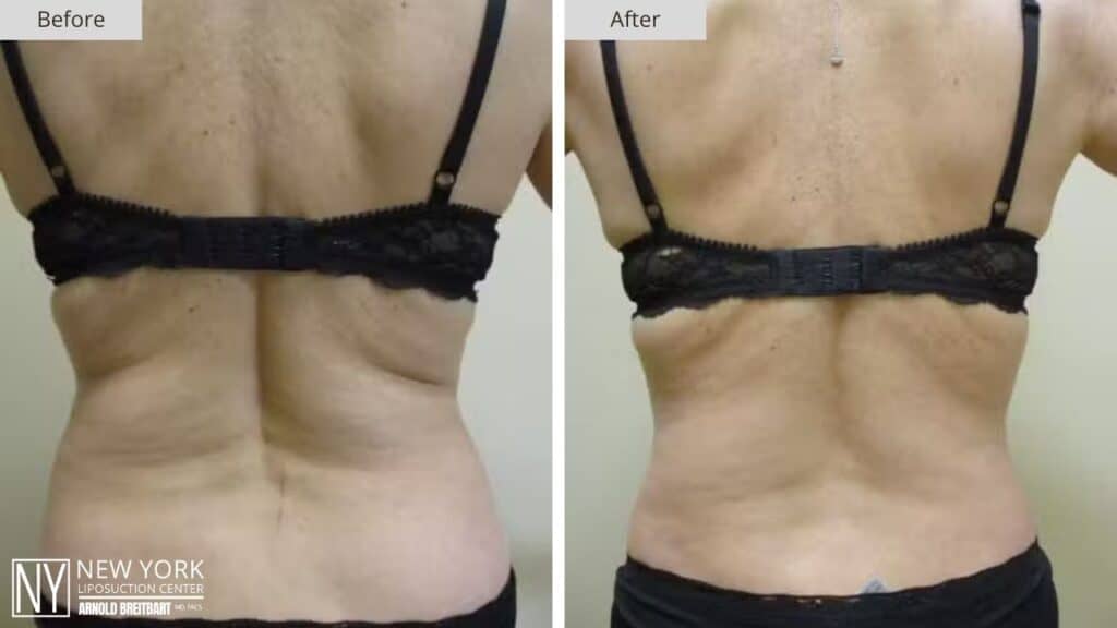 New York Back Liposuction Before and After Patient 3