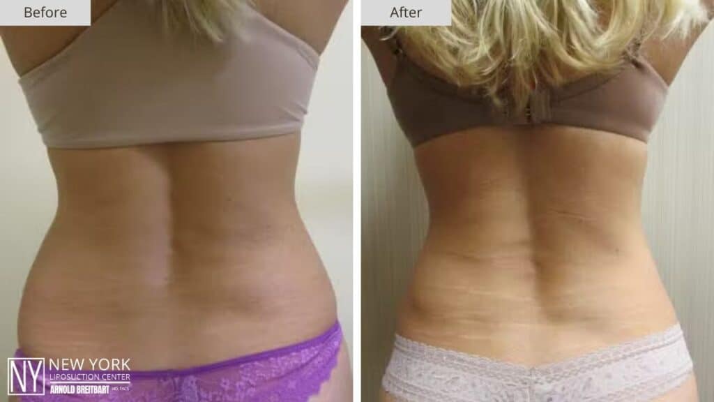 New York Back Liposuction Before and After Patient 4