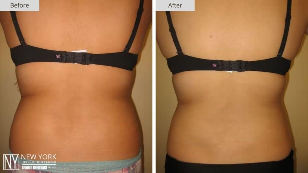 New York Back Liposuction Before and After Patient 5