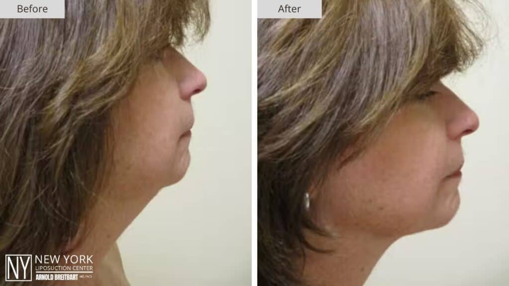 New York Chin Liposuction Before and After Face Patient 1