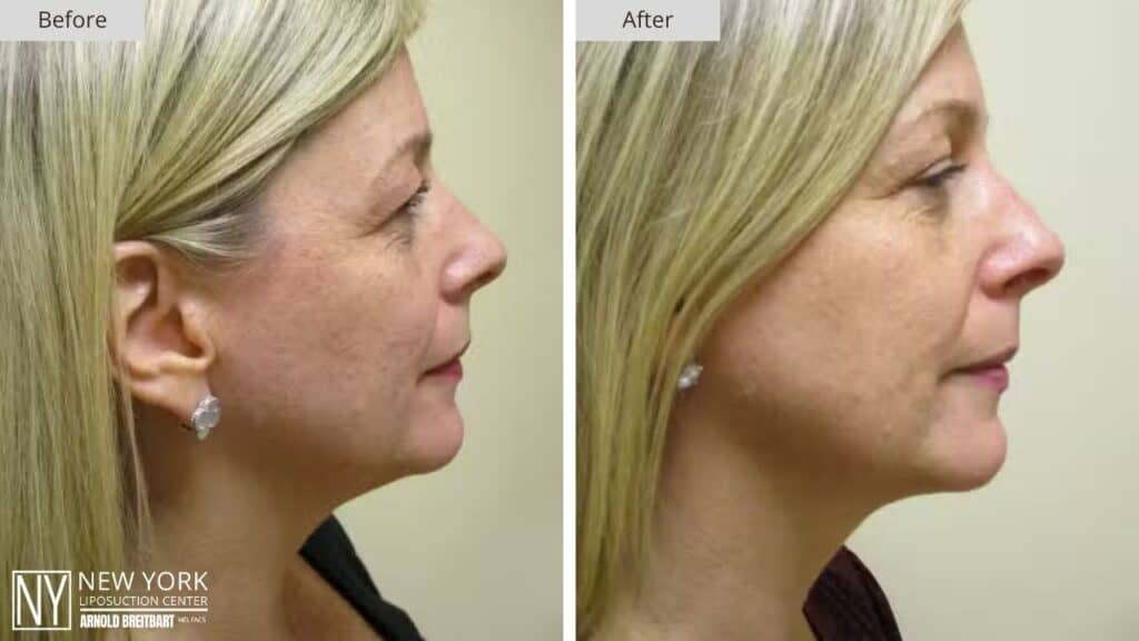 New York Chin Liposuction Before and After Patient 2