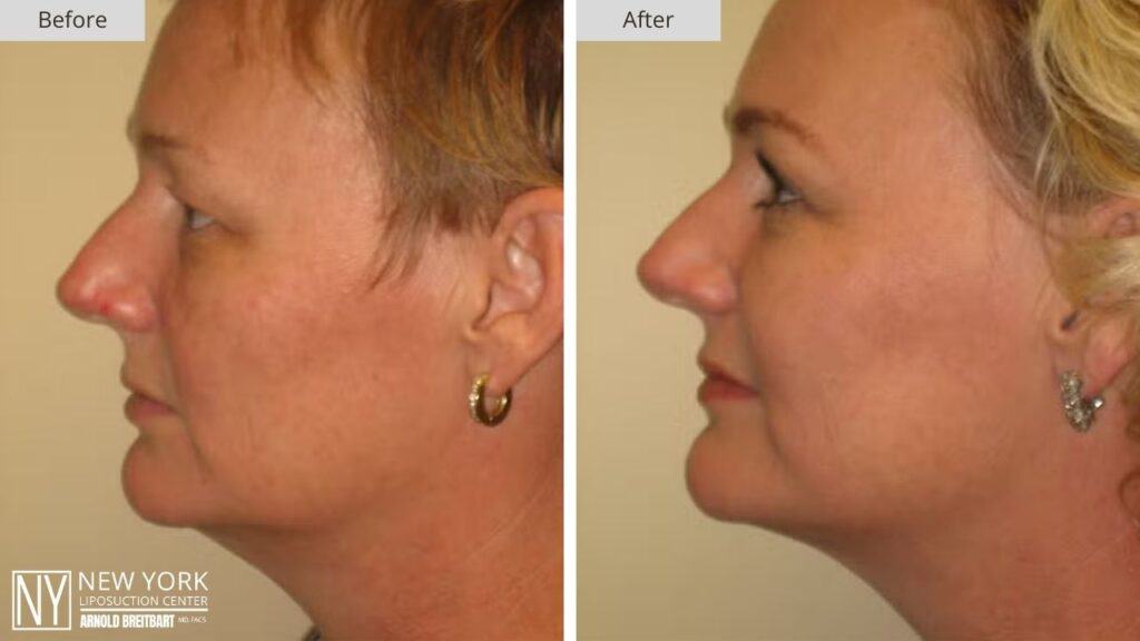 New York Chin Liposuction Before and After Patient 3