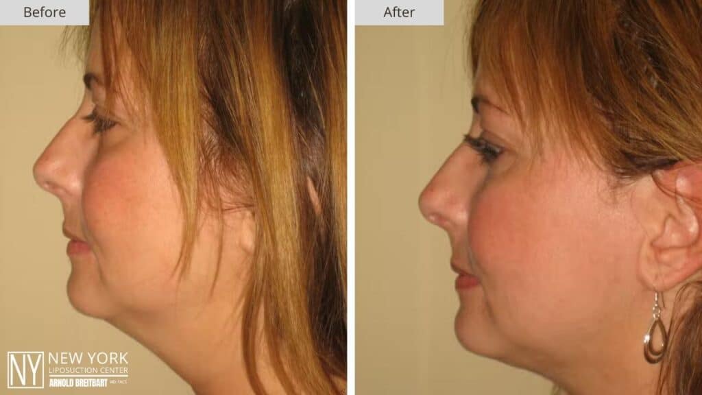 New York Chin Liposuction Before and After Patient 4