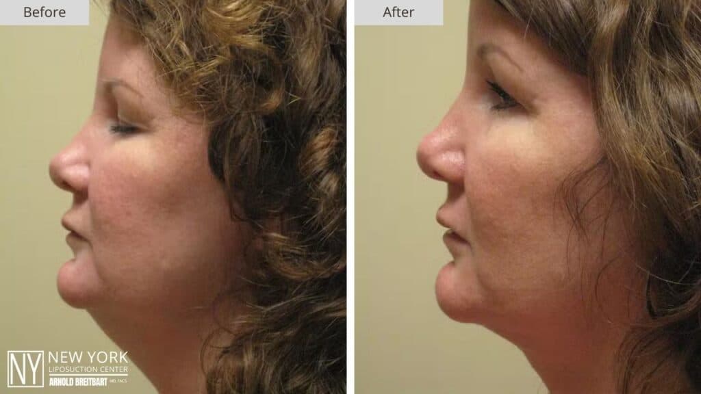 New York Chin Liposuction Before and After Patient 5