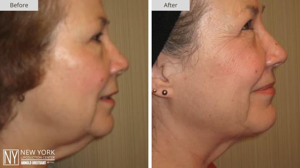 New York Chin Liposuction Before and After Patient 6