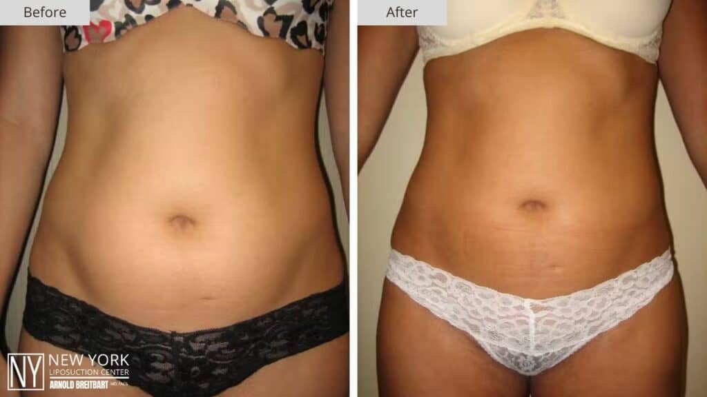 New York FUPA Liposuction Before and After Front Patient 1