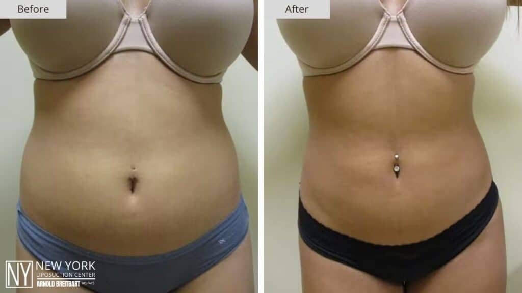 New York FUPA Liposuction Before and After Front Patient 2