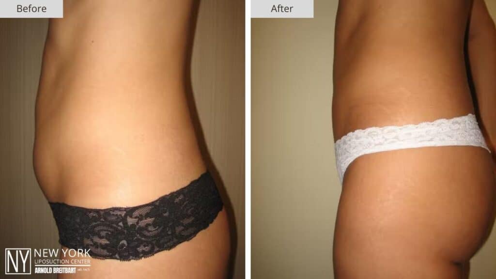 New York FUPA Liposuction Before and After Side Patient 1