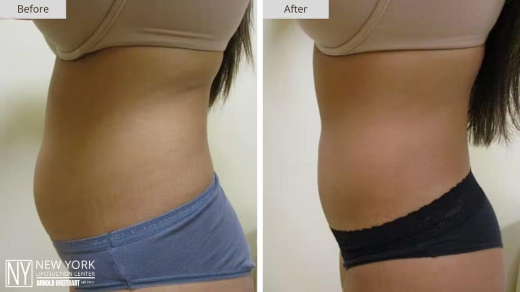 New York FUPA Liposuction Before and After Side Patient 2