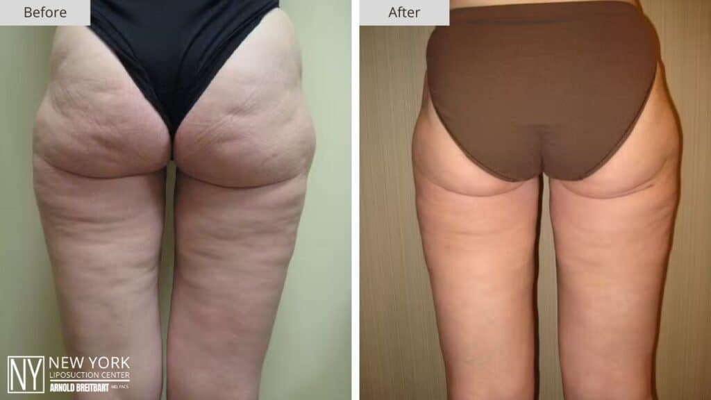 New York Hip Liposuction Before and After Back Patient 1