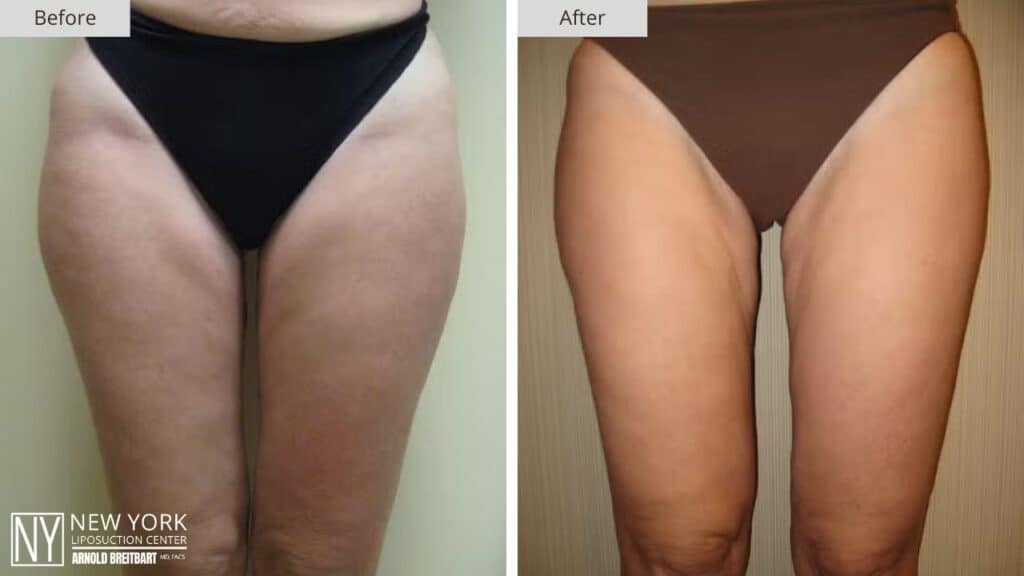 New York Hip Liposuction Before and After Front Patient 1